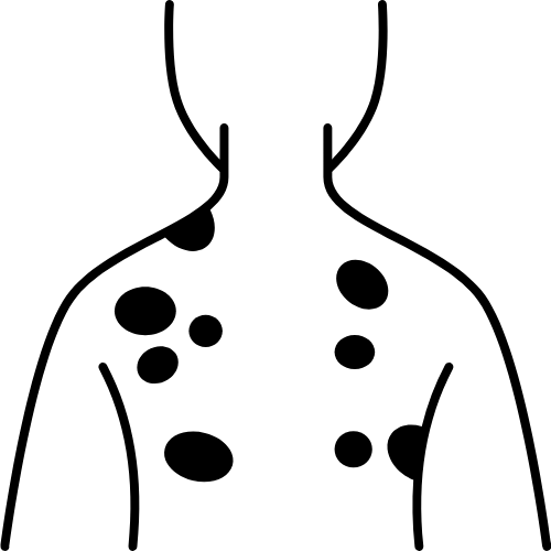 Cirurgia do melanoma